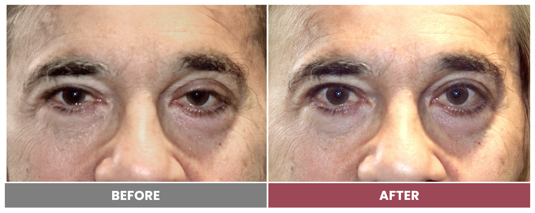 PTOSIS REPAIR - Case 38